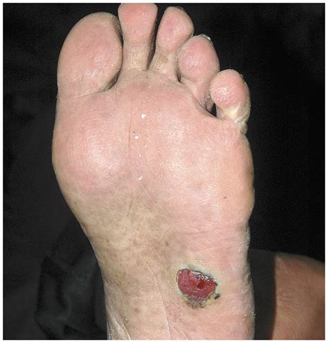 melanoma on feet pictures